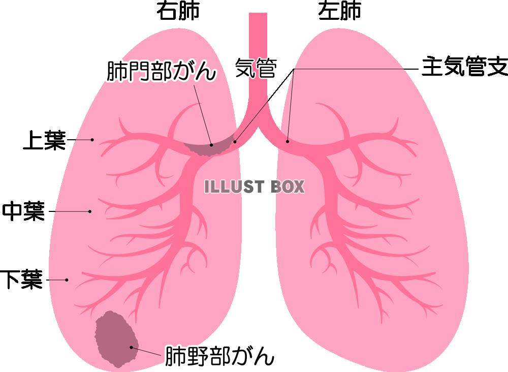 肺がん(png・CSeps）