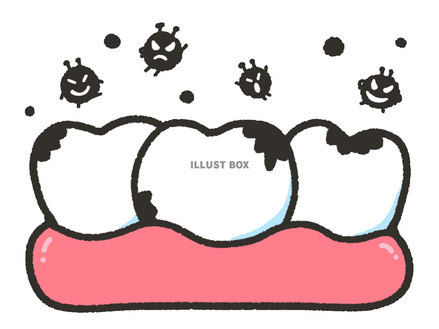 虫歯の歯とばい菌