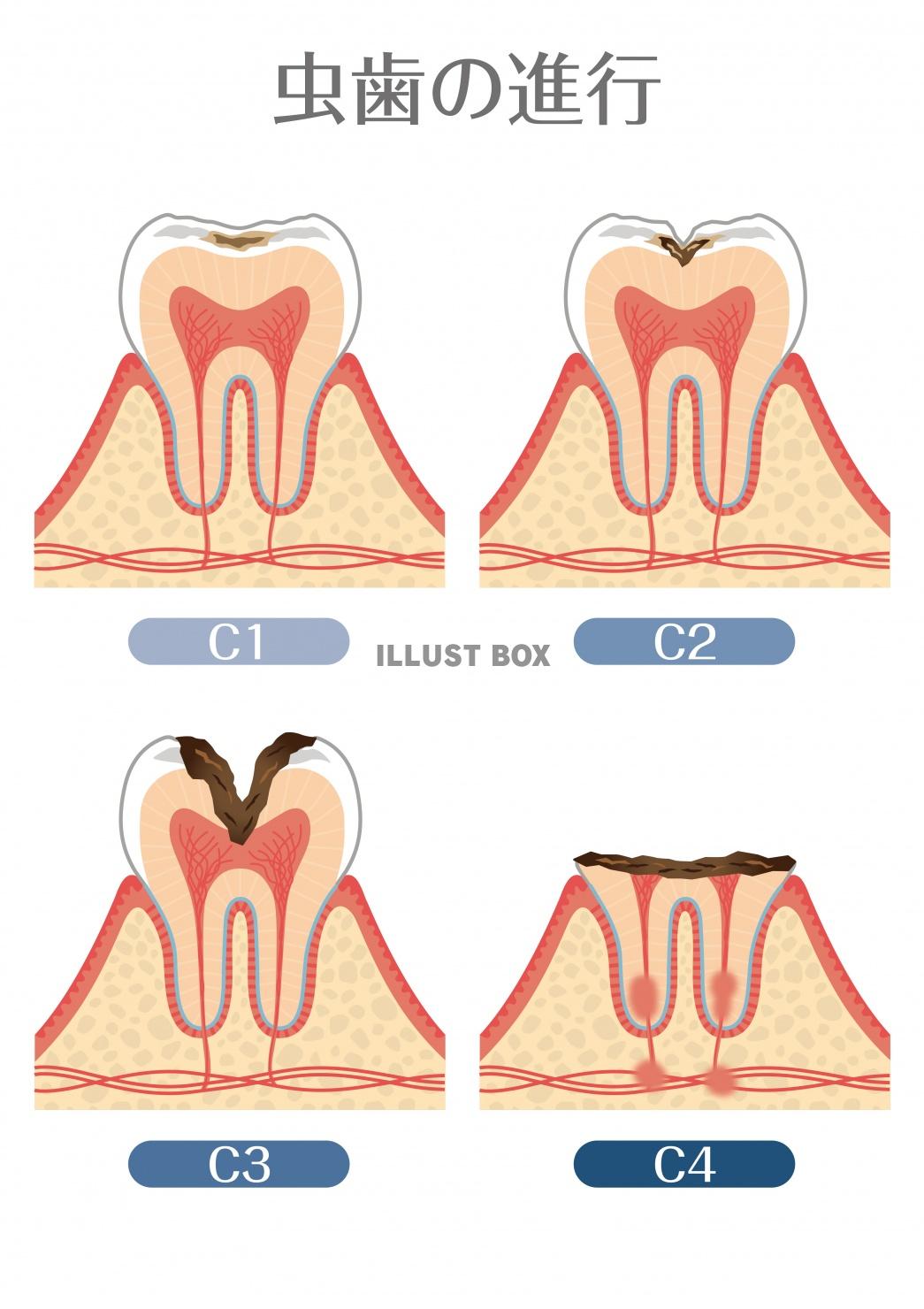 歯のイラスト★虫歯の進行★断面図