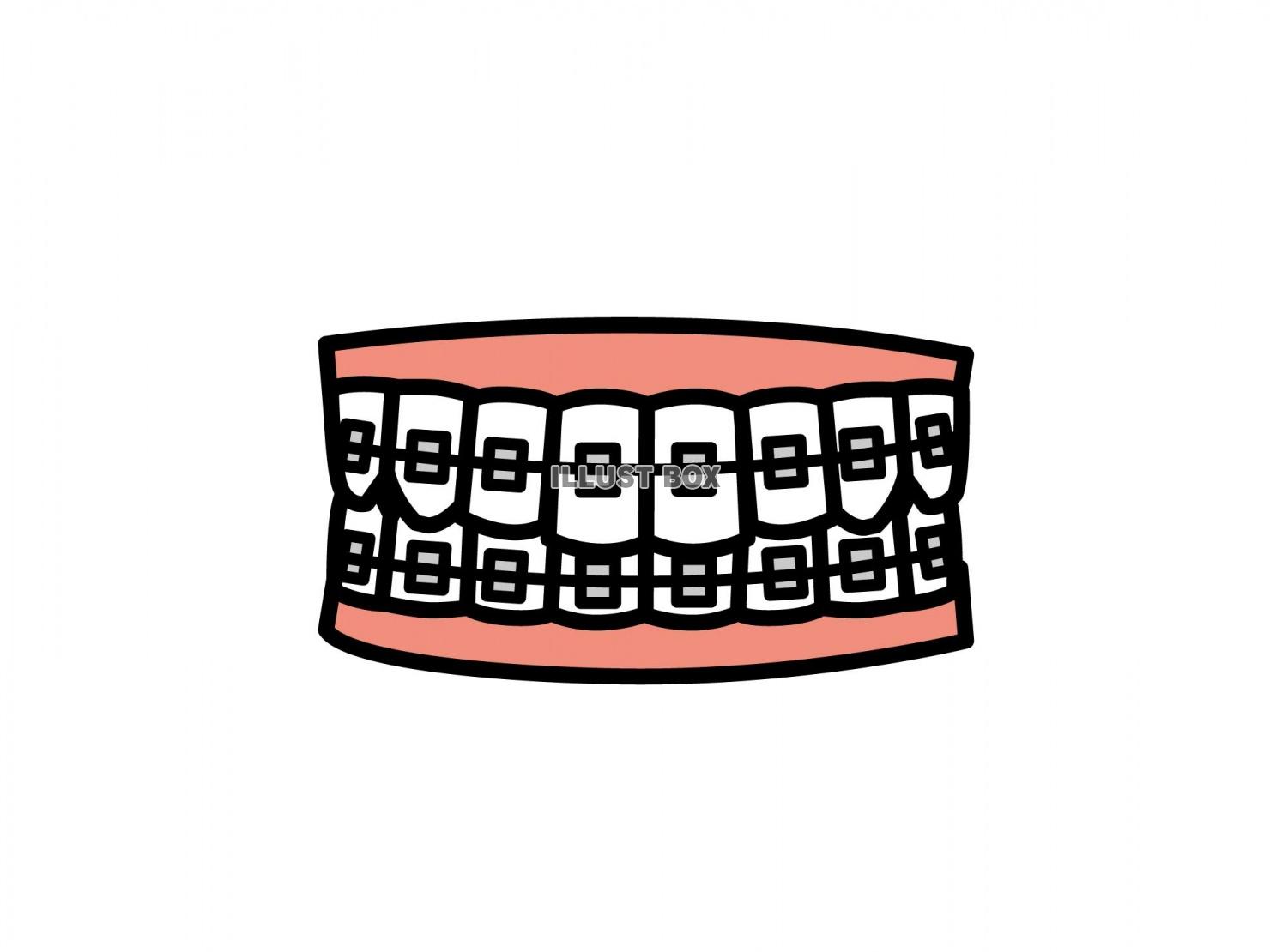歯列矯正のイラスト