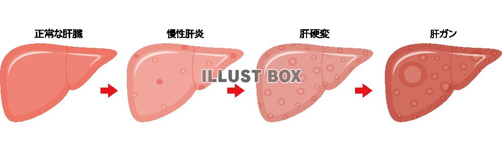 無料イラスト 肝臓の病気進行 Png Cseps