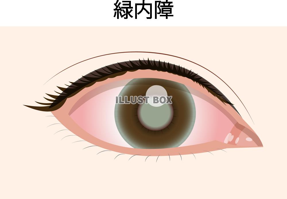 緑内障(png・CSeps)