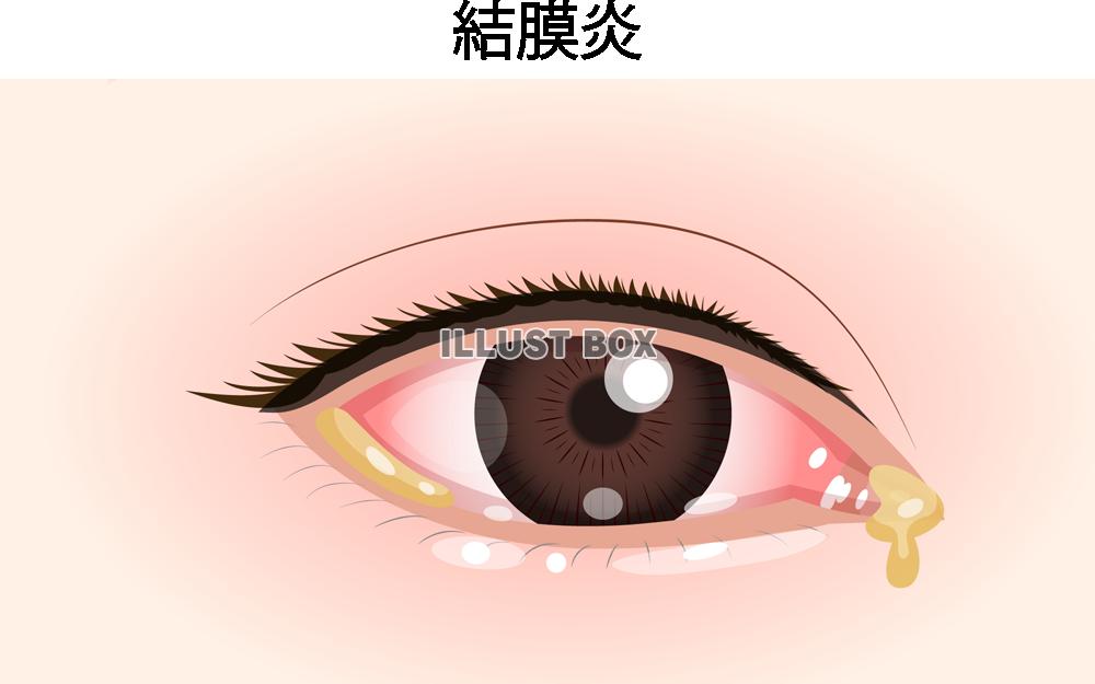 結膜炎(png・CSeps)