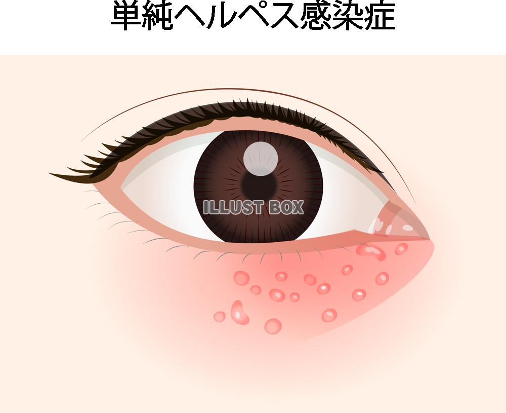 単純ヘルペス感染症(png・CSeps)