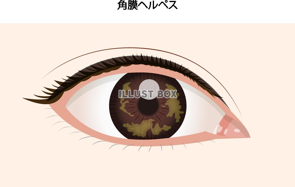 角膜ヘルペス(png・CSeps)