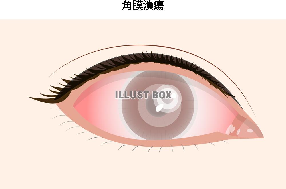 角膜潰瘍(png・CSeps)