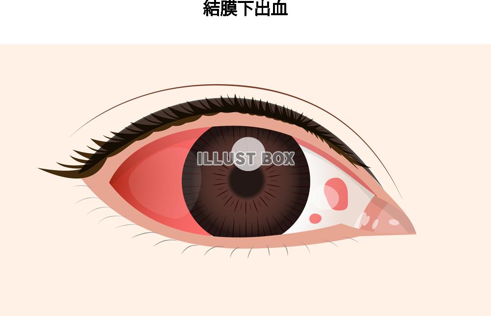 結膜下集結(png・CSeps)