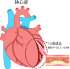 心臓の病気(png・CSeps）