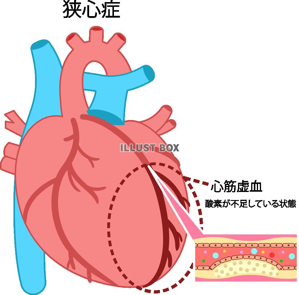 心臓の病気(png・CSeps）