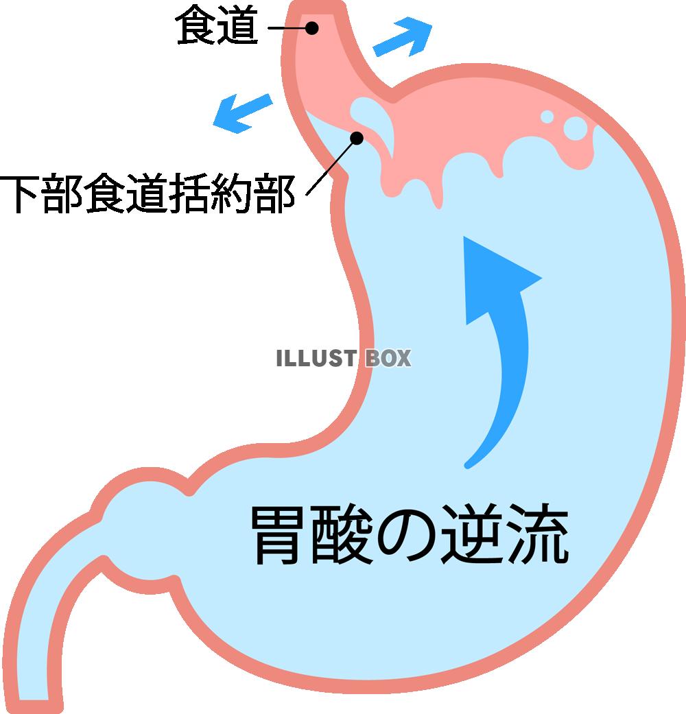 胃酸の逆流(png・CSeps）