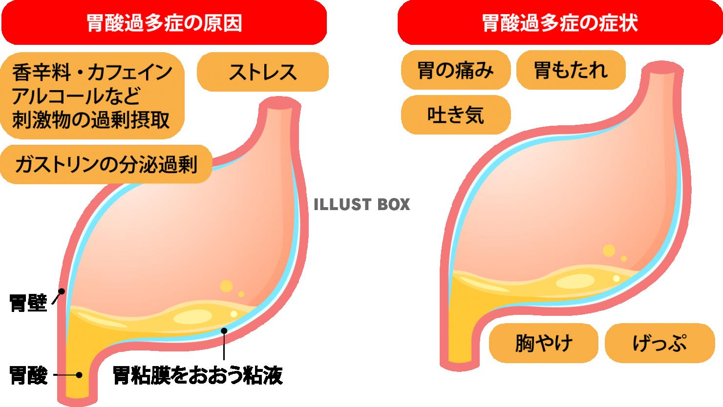 胃酸 過多 症状 チェック