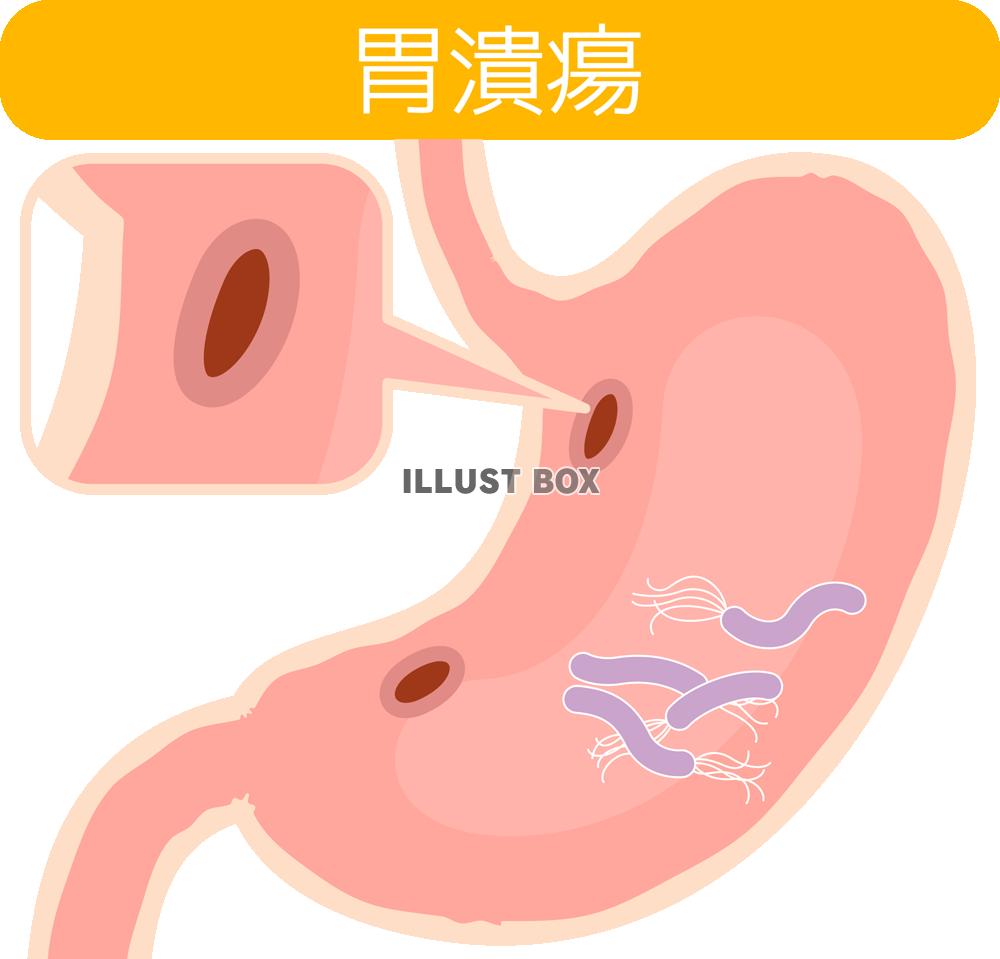胃潰瘍(png・CSeps）