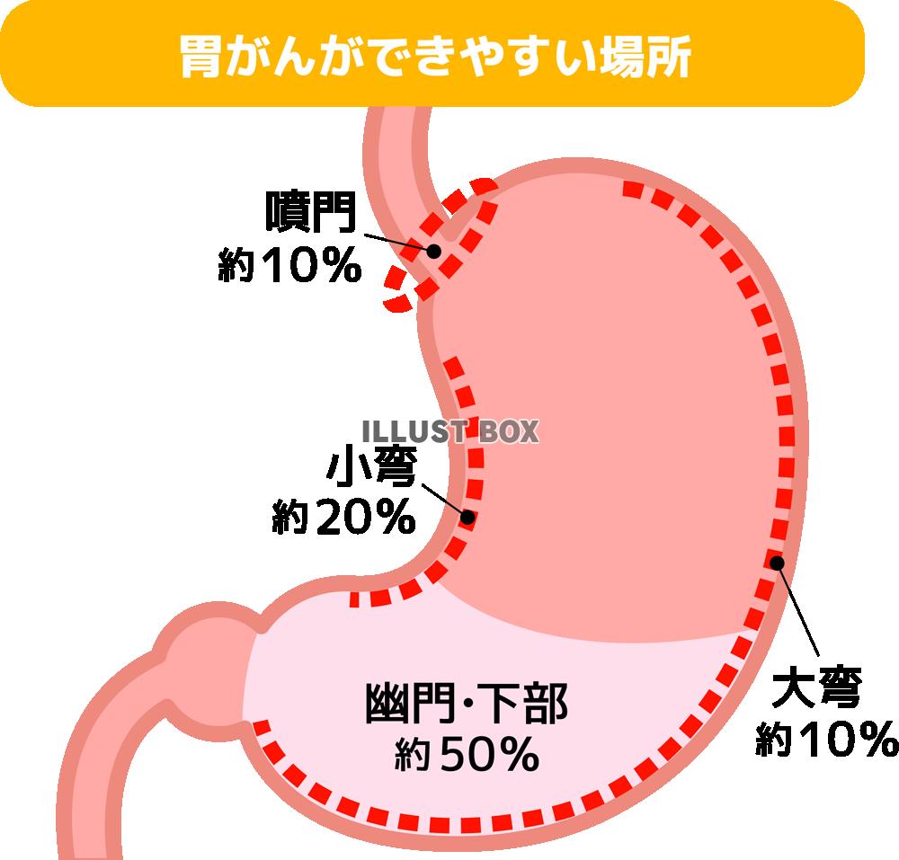 胃ガンのできやすい場所(png・CSeps）