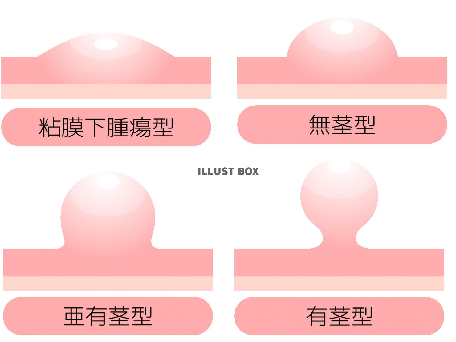 ポリープの形の種類(png・CSeps)