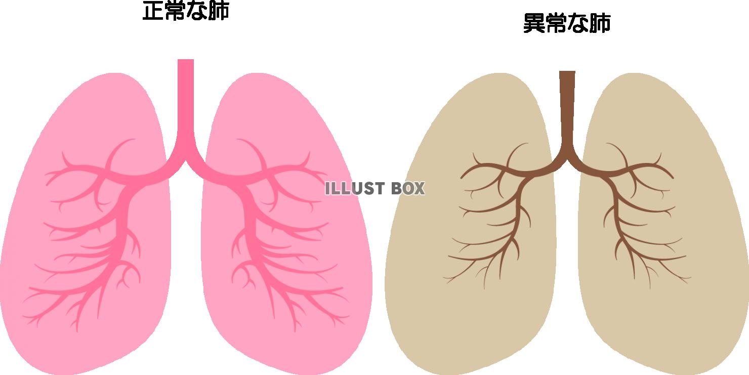 無料イラスト 正常 異常の肺 Png Cseps