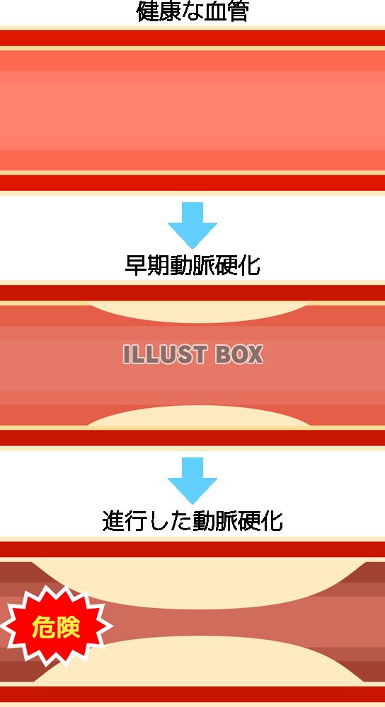 無料イラスト 動脈硬化進行 Png Cseps