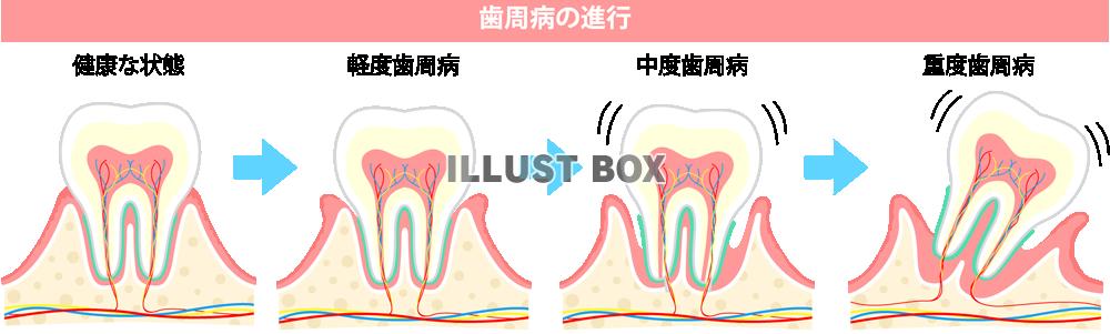 無料イラスト 歯周病の進行 Png Cseps