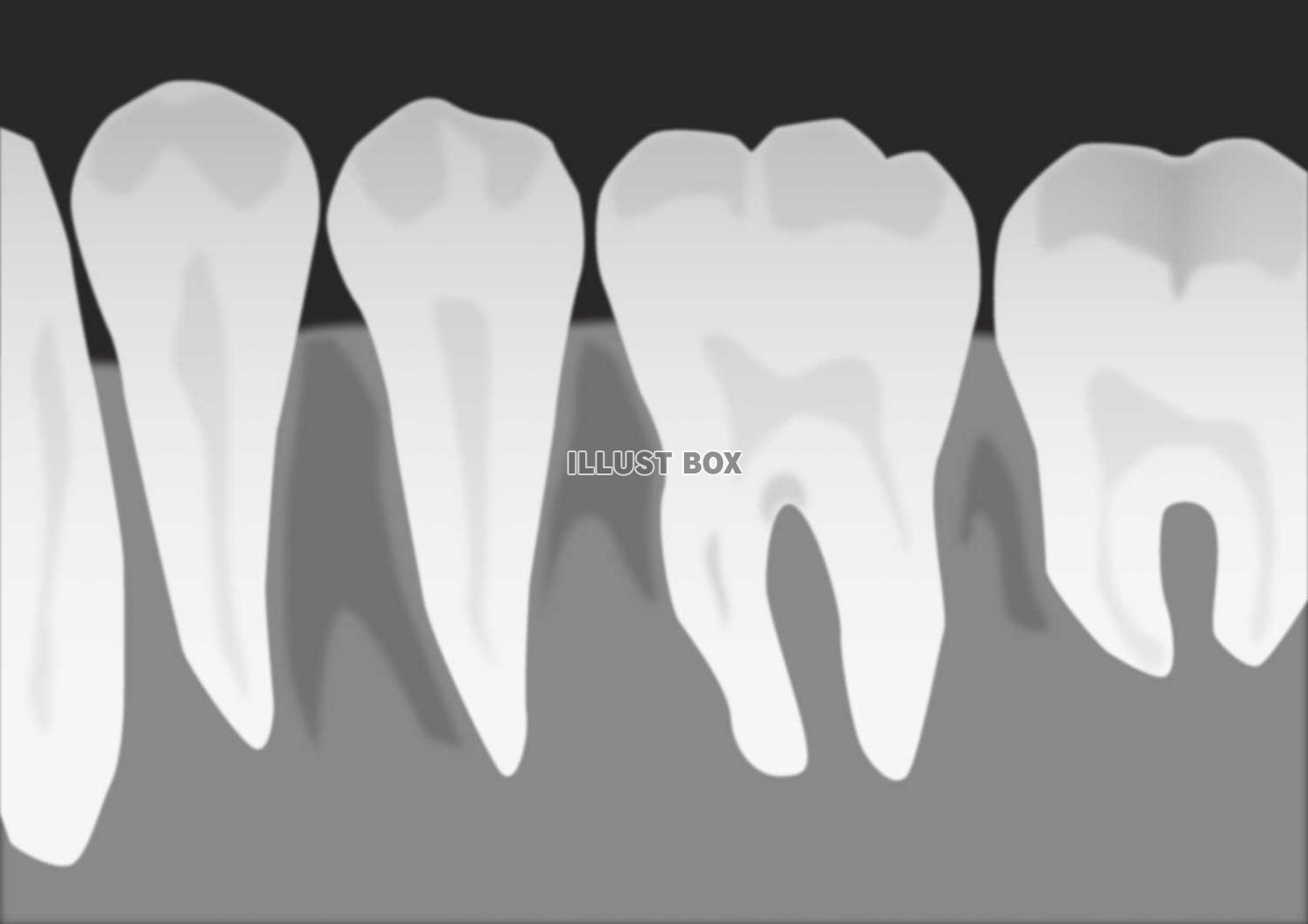 無料イラスト 歯 レントゲン写真
