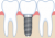 インプラント