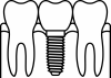 インプラント