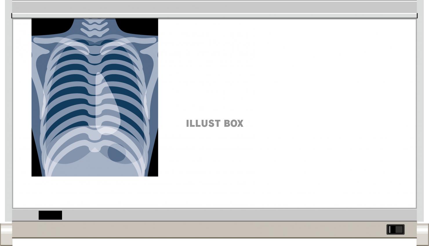 無料イラスト レントゲン 写真 シャウカステン フレーム