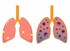 健康な肺と病気の肺
