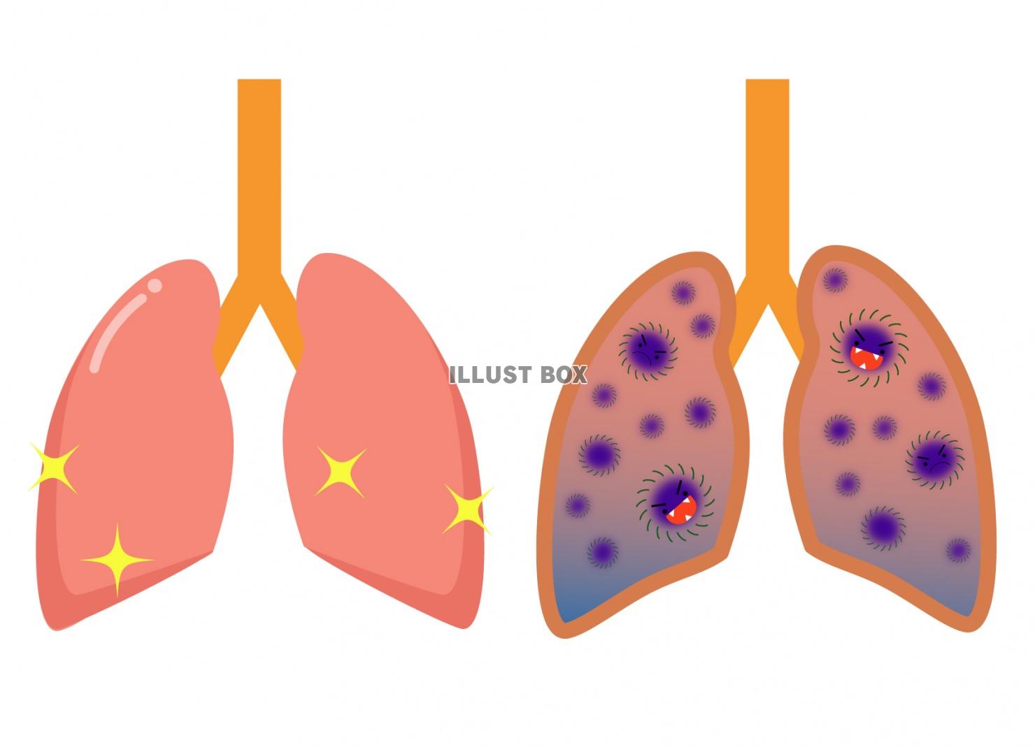 健康な肺と病気の肺