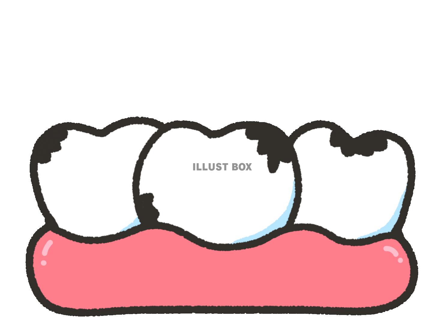 無料イラスト シンプルな虫歯の歯