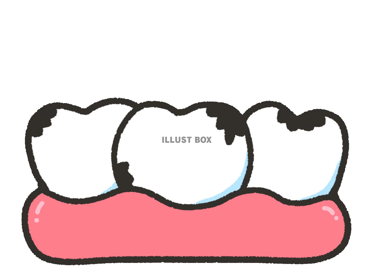 虫歯 イラスト無料