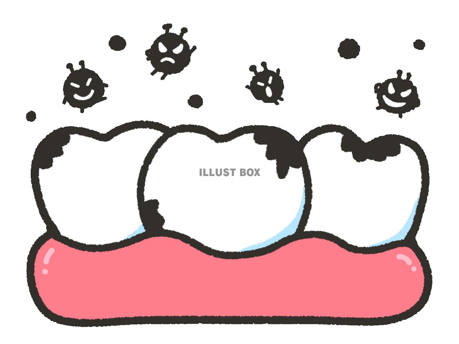 無料イラスト 虫歯の歯とばい菌