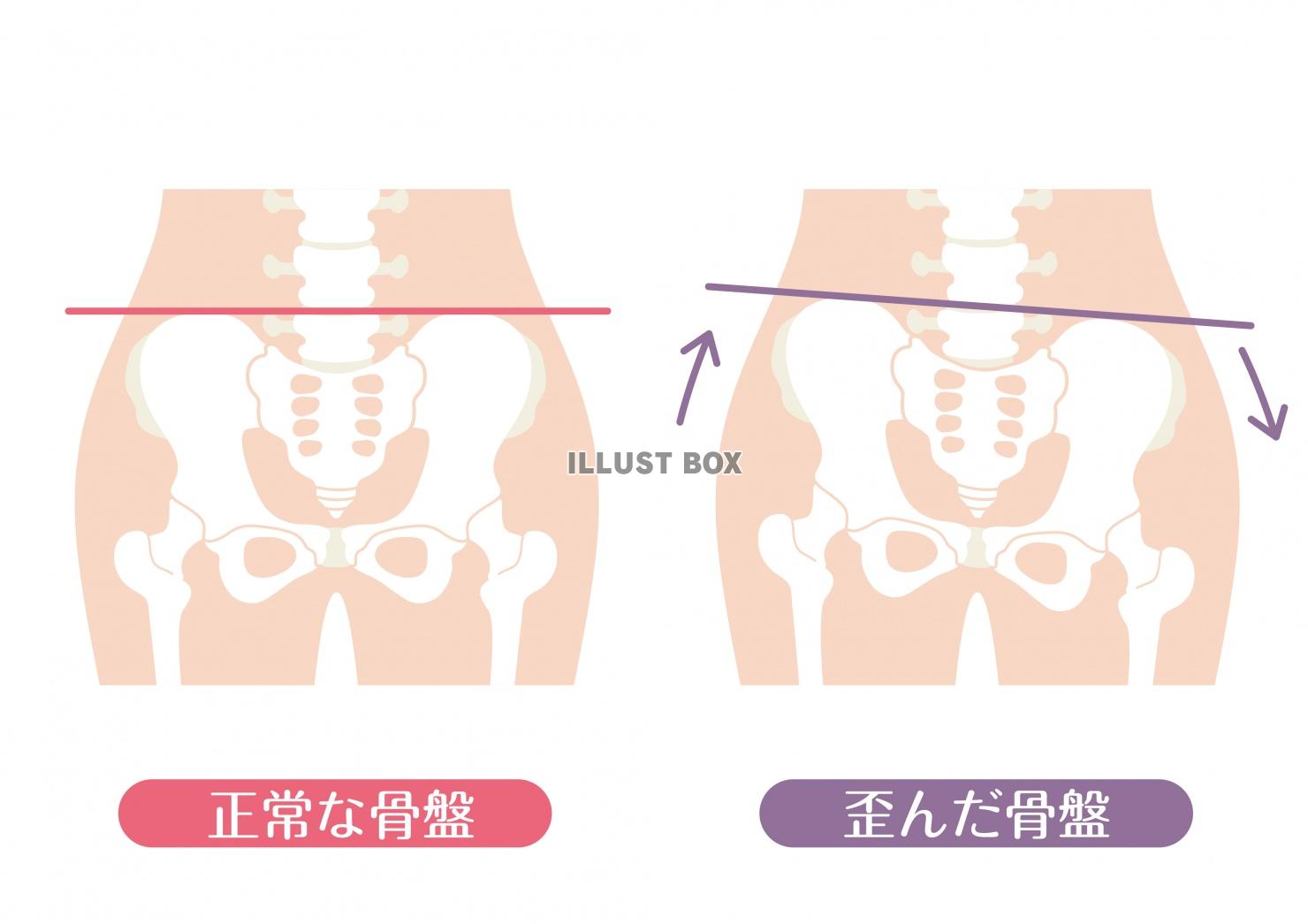 無料イラスト 人間の身体 正常な骨盤と歪んだ骨盤 比較イラスト