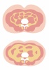 肥満のタイプ★皮下脂肪と内臓脂肪