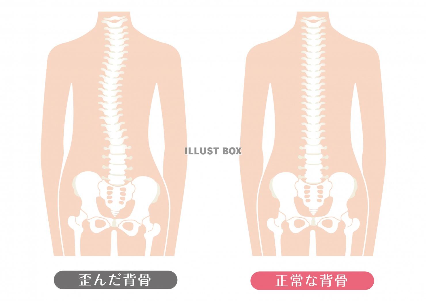 人間の身体★歪んだ背骨と正常な背骨イラスト★