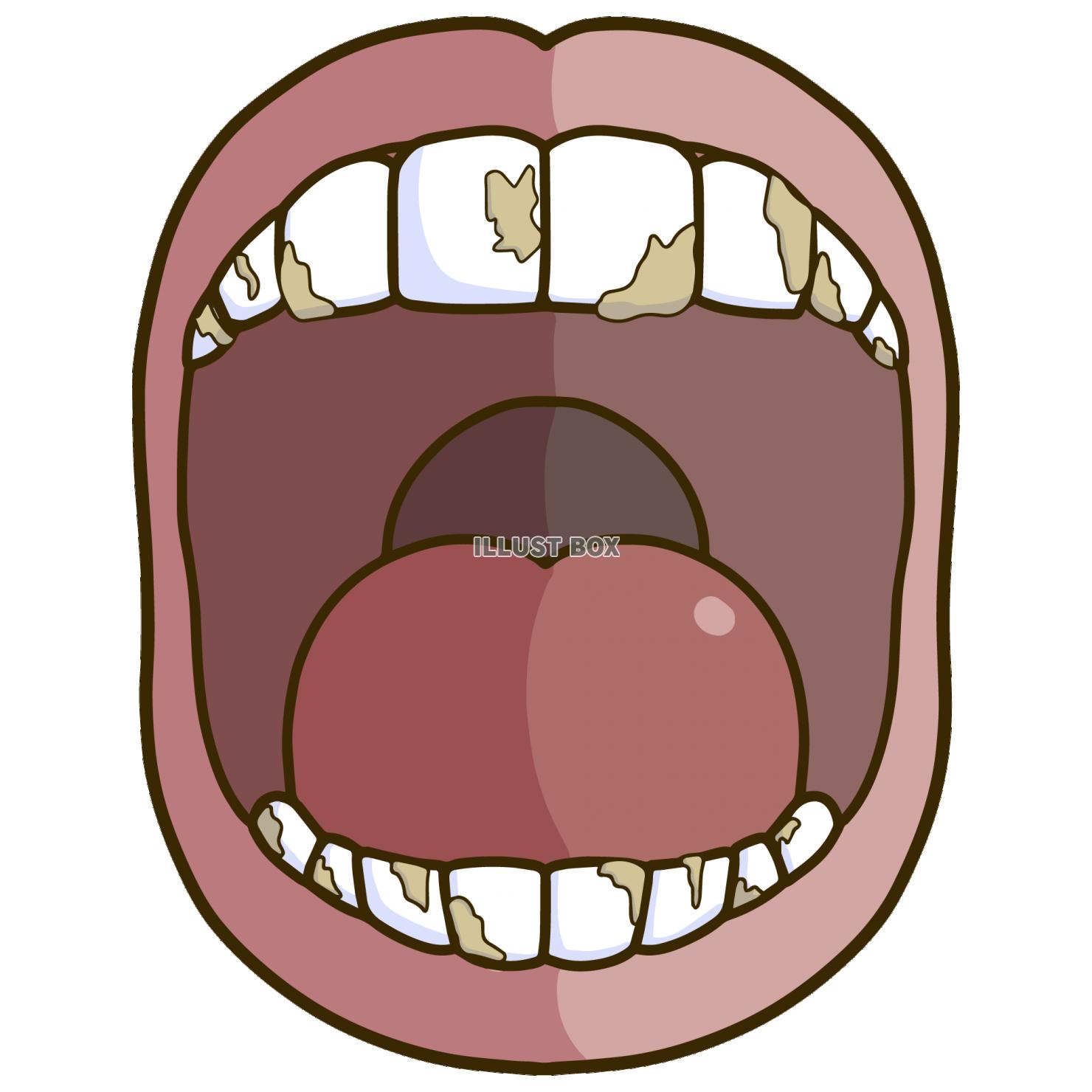 歯垢や歯石が溜まった歯のイラスト