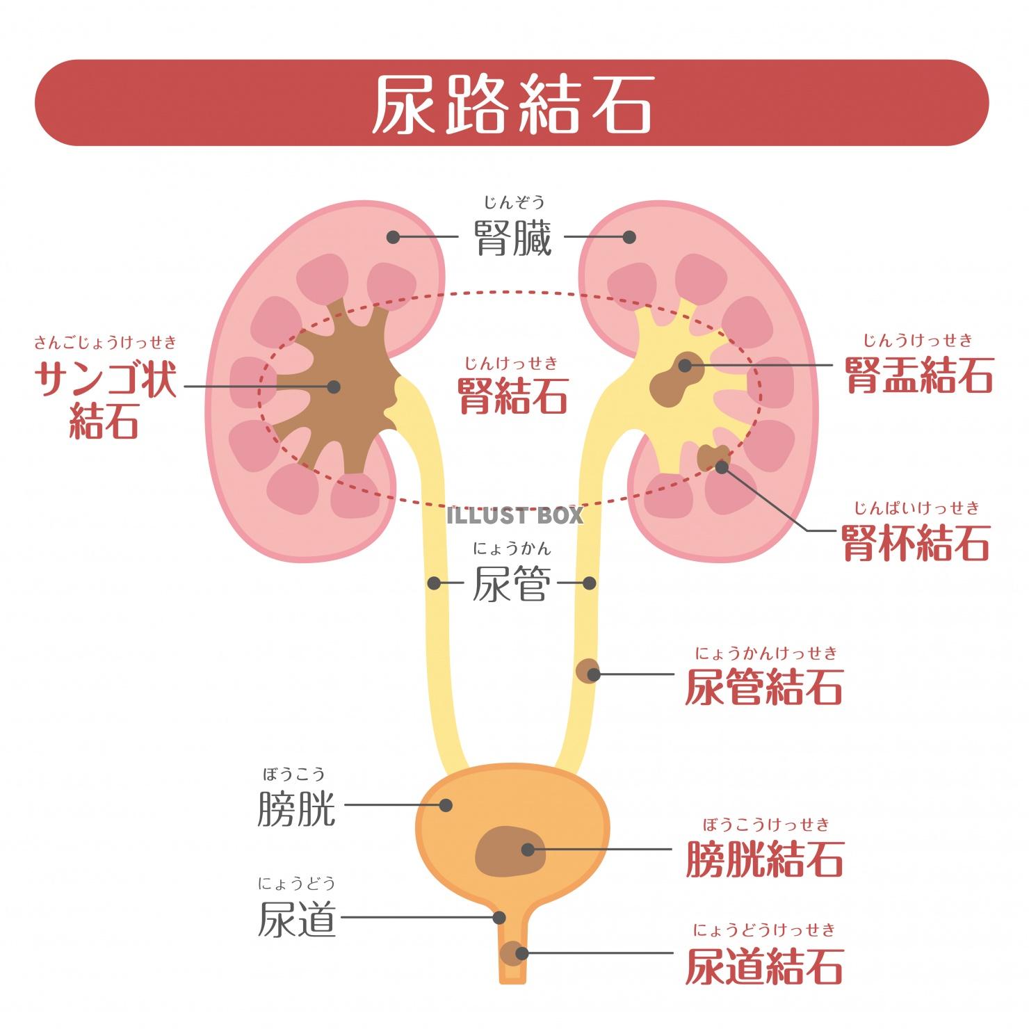 人間の身体★泌尿器★尿路結石★文字あり