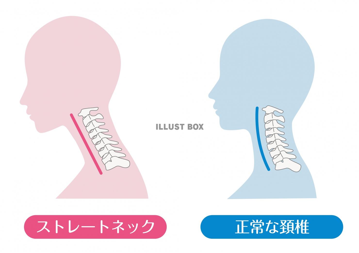 人間の身体★首★正常な頚椎とストレートネック★スマホ首