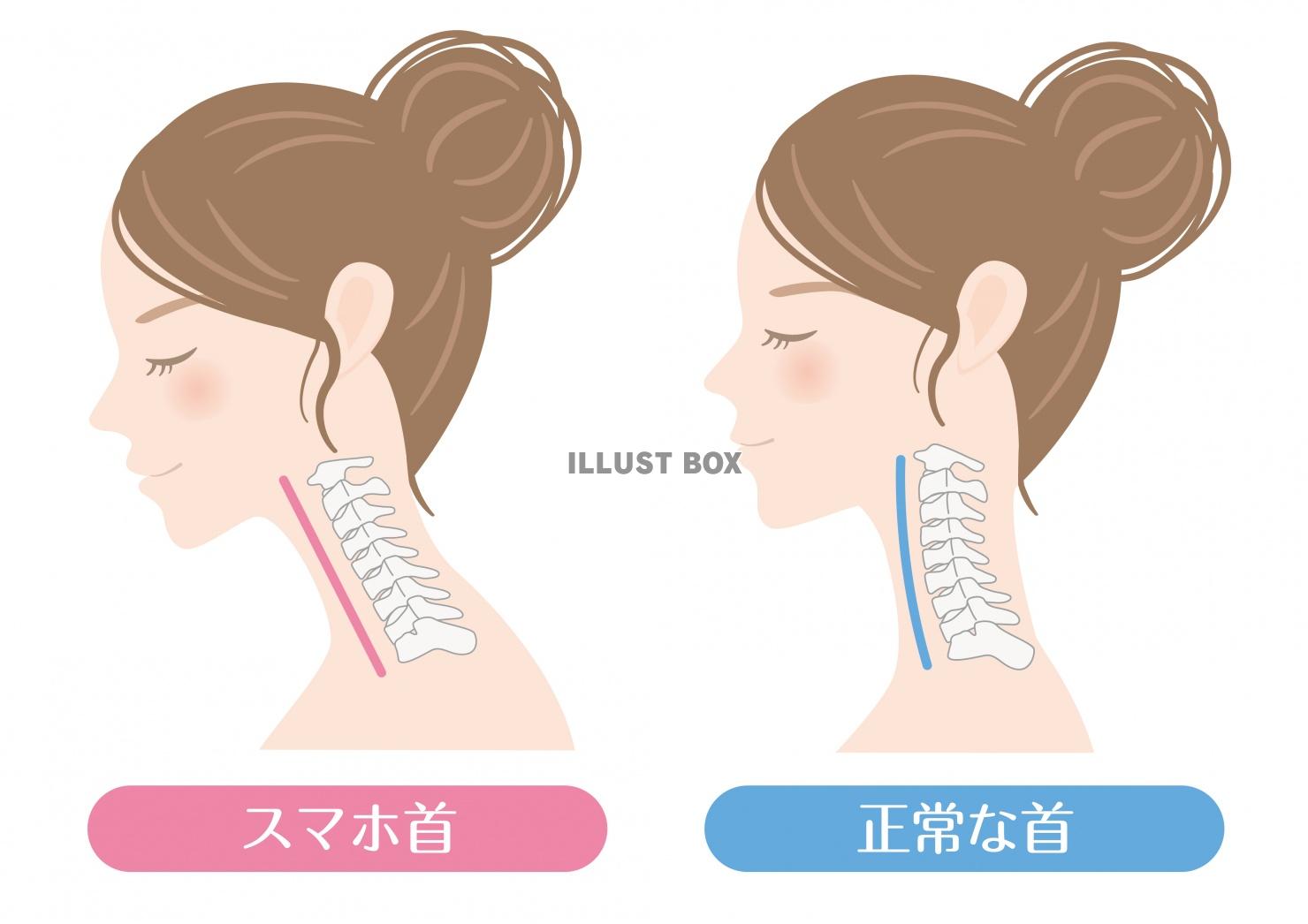 人間の身体☆首☆正常な頚椎とストレートネック☆スマホ首：イラスト無料