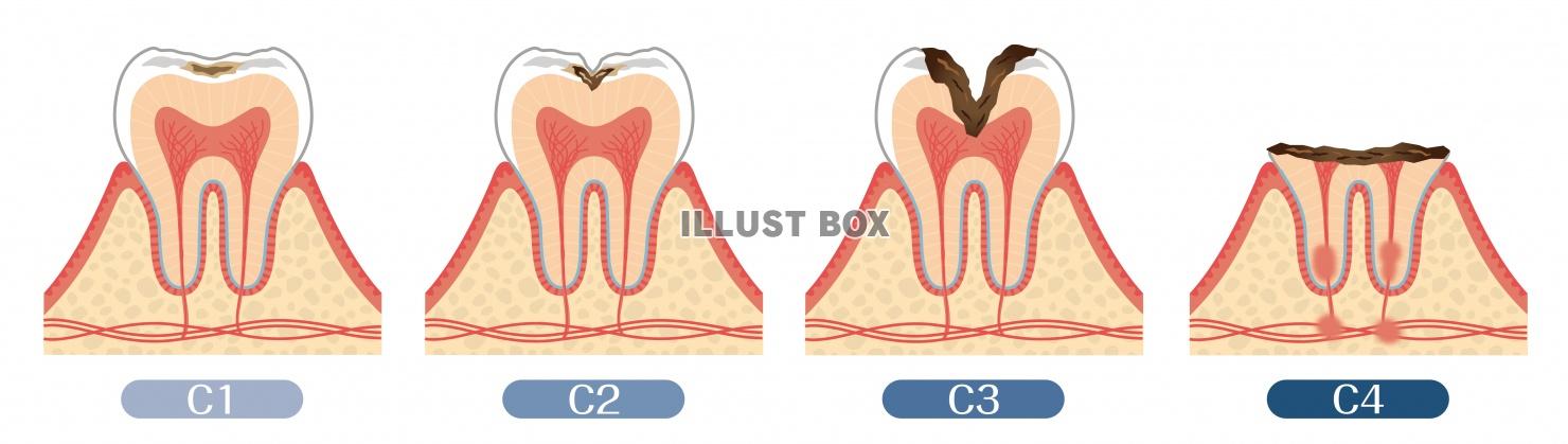 歯のイラスト★虫歯の進行★断面図