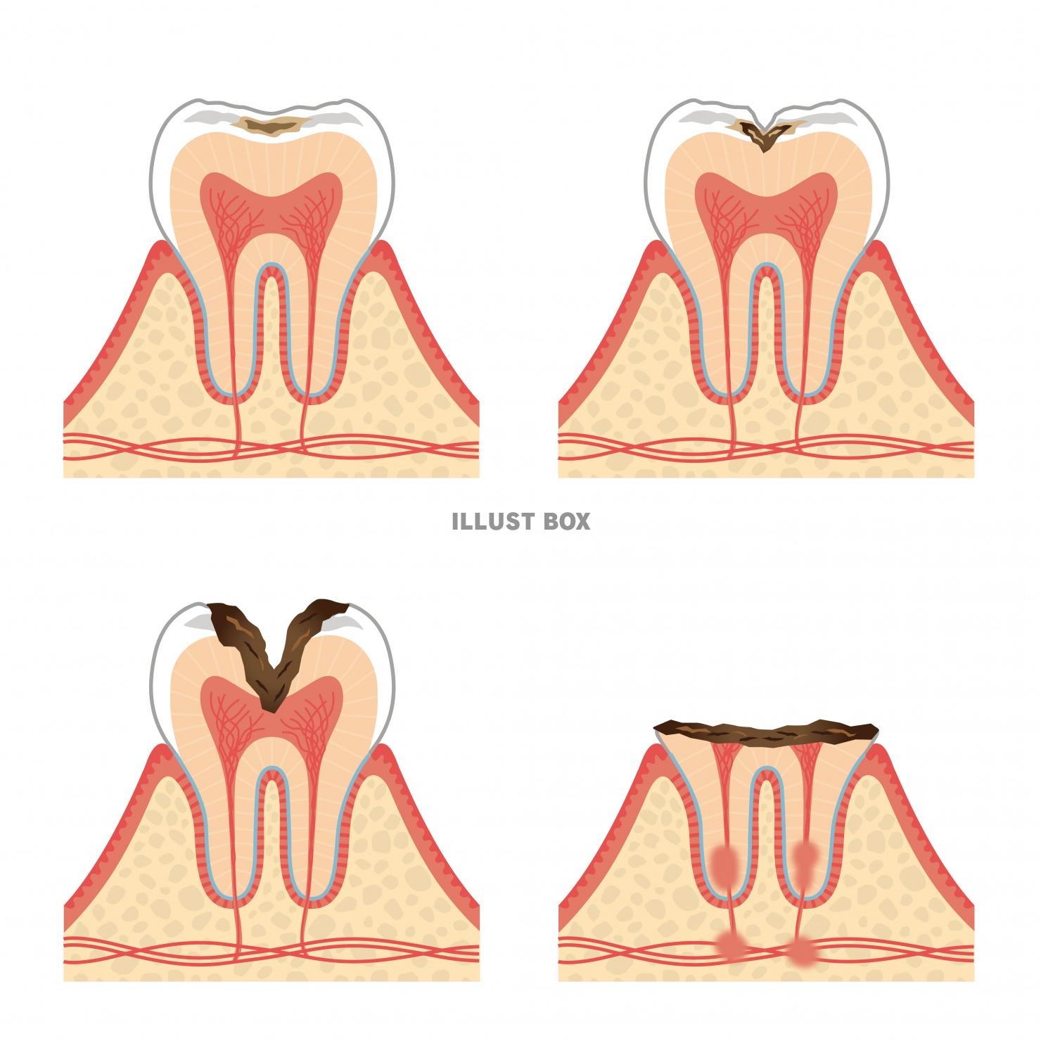 歯のイラスト★虫歯の進行★断面図