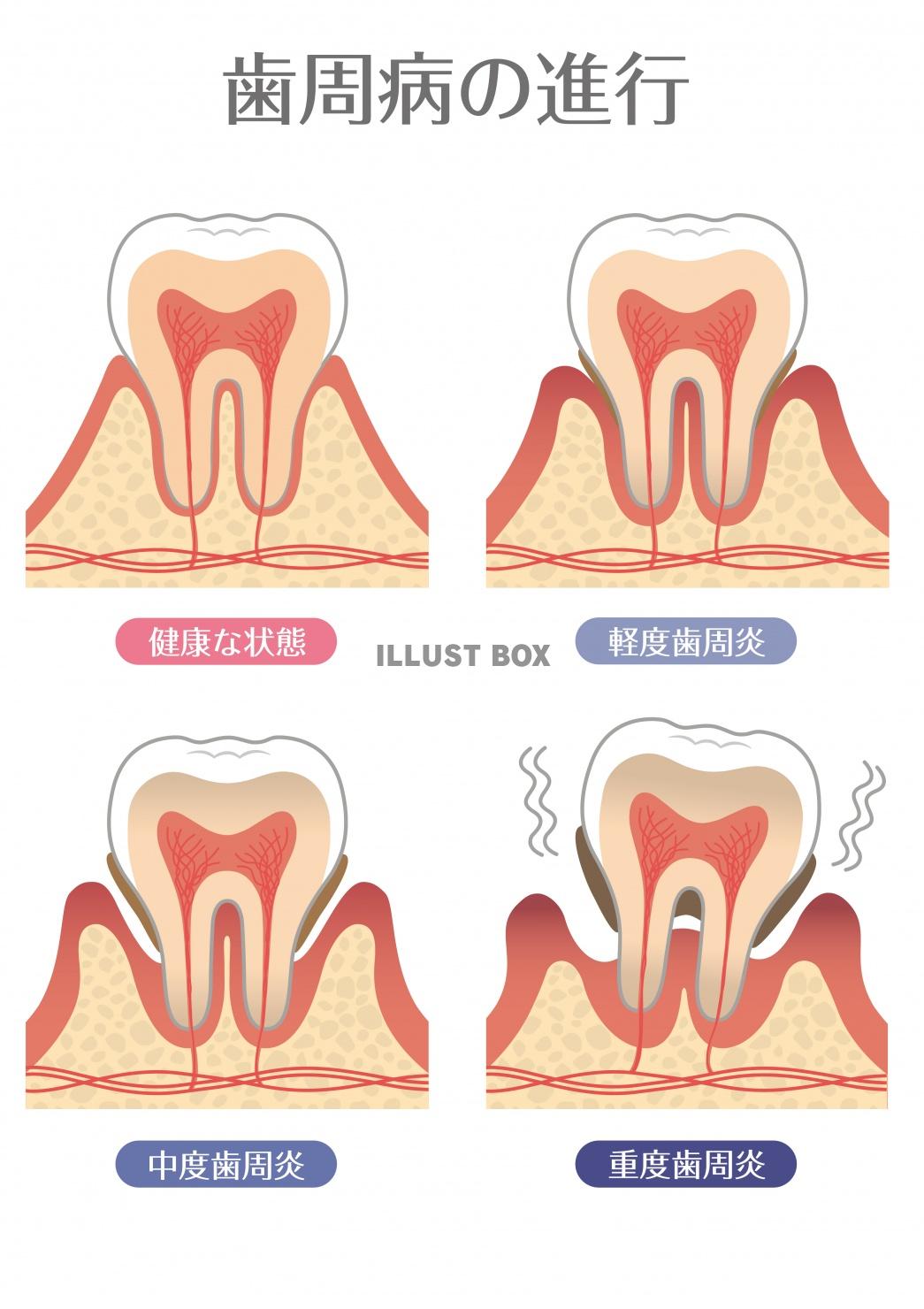 歯のイラスト★歯周病の進行★断面図