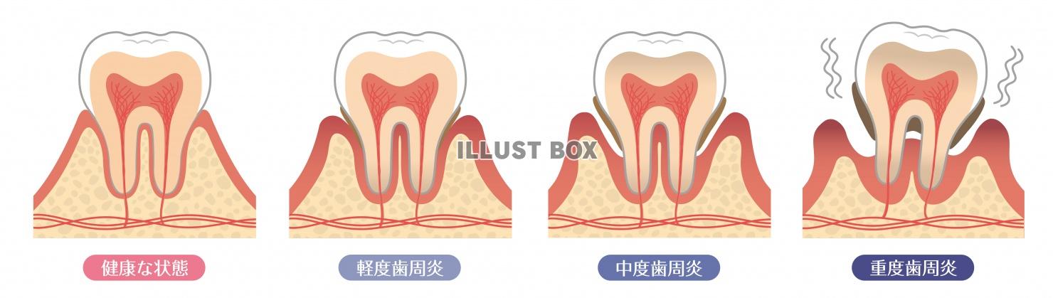 歯のイラスト★歯周病の進行★断面図