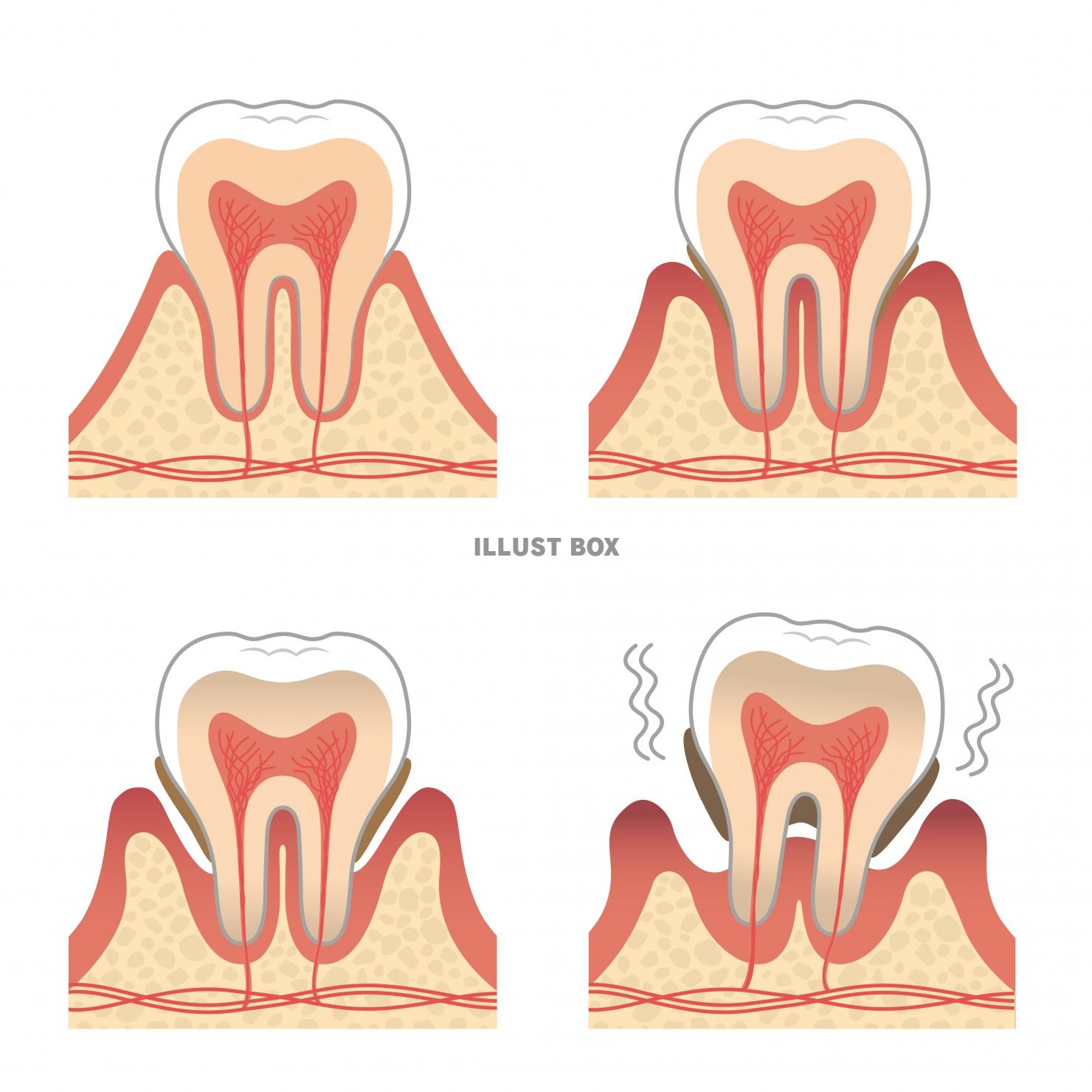 歯のイラスト★歯周病の進行★断面図