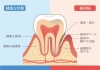 歯のイラスト★健康な歯と歯周病の歯★断面図